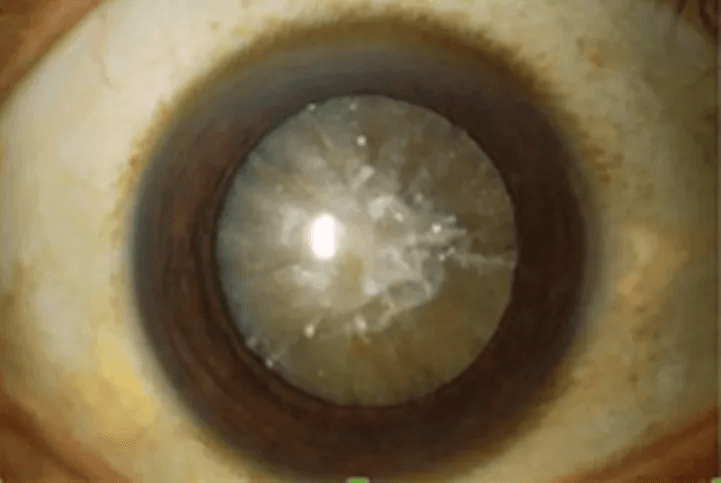 Cataract in Singapore