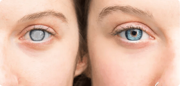 Signs & Symptoms of Glaucoma