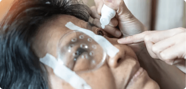 Glaucoma Surgery Aftercare