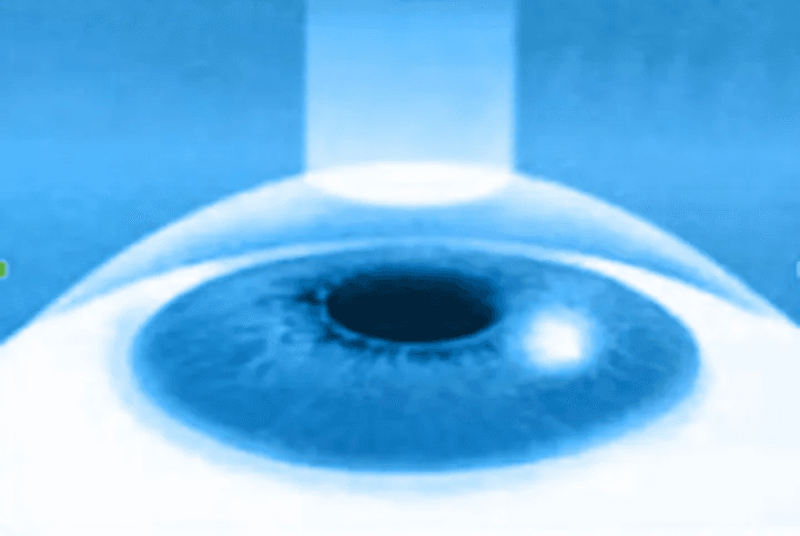 Epi-LASIK Surgery